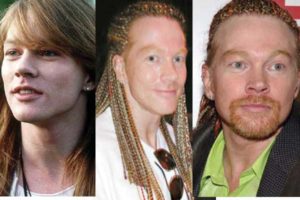 axl rose plastic surgery before and after photos