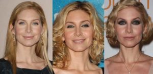 elizabeth mitchell plastic surgery before and after photos