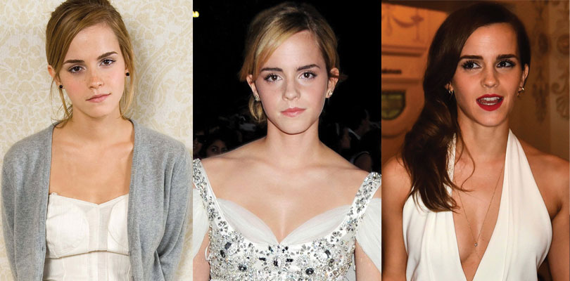 emma watson before and after plastic surgery 2024