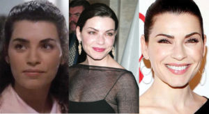 julianna margulies plastic surgery before and after photos