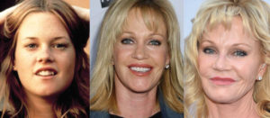 melanie griffith plastic surgery before and after