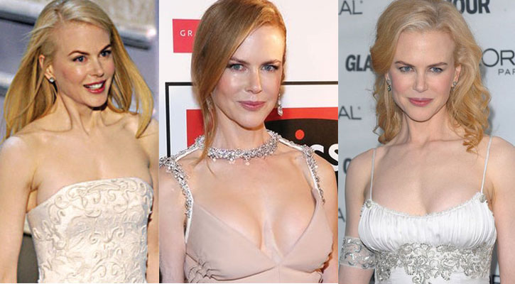 nichole kidman before and after plastic surgery 2022